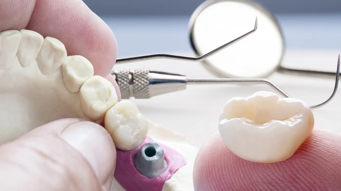 zubní implantace