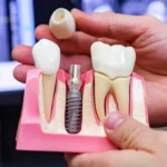 1747824321_pro-koho-jsou-vhodne-jednostupnove-zubni-implantaty.webp.webp